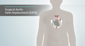 surgical aortic valve replacement